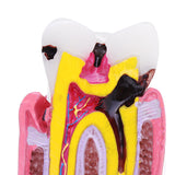 Human,Dental,Caries,Teeth,Tooth,Decay,Comparison,Model,Pathology,Patient,Education,Medical,Model