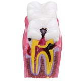 Human,Dental,Caries,Teeth,Tooth,Decay,Comparison,Model,Pathology,Patient,Education,Medical,Model