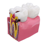 Human,Dental,Caries,Teeth,Tooth,Decay,Comparison,Model,Pathology,Patient,Education,Medical,Model