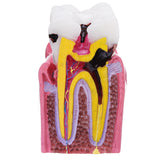 Human,Dental,Caries,Teeth,Tooth,Decay,Comparison,Model,Pathology,Patient,Education,Medical,Model