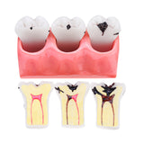 Detachable,Human,Dental,Caries,Teeth,Tooth,Decay,Comparison,Model,Pathology,Patient,Education,Medical,Model