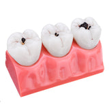 Detachable,Human,Dental,Caries,Teeth,Tooth,Decay,Comparison,Model,Pathology,Patient,Education,Medical,Model