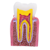 Human,Dental,Caries,Teeth,Tooth,Decay,Comparison,Model,Pathology,Patient,Education,Medical,Model